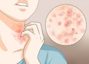 Drie gemakkelijke huismiddelen tegen schurft