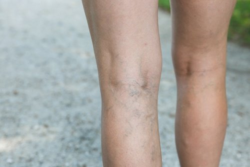 Spataderen natuurlijk behandelen met lotion van olijfolie en knoflook