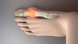 Je urinezuurgehalte verlagen met deze voeding