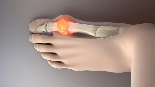 Je urinezuurgehalte verlagen met deze voeding