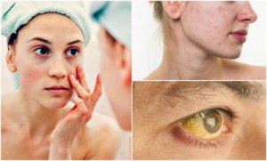 7 tekenen van voedingstekorten in je gezicht