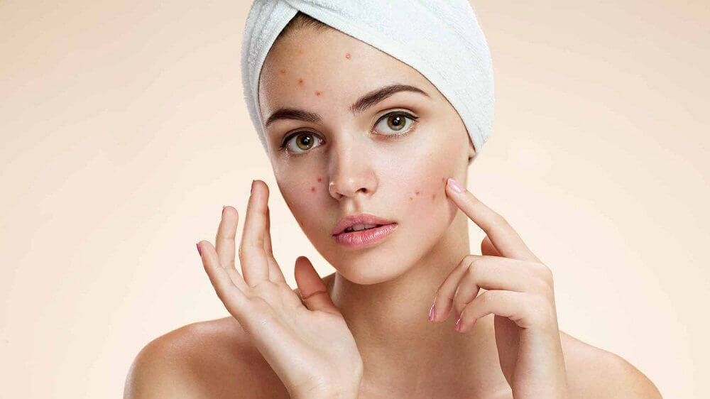 Een van de schoonheidsgeheimpjes met appelazijn is het behandelen van acne