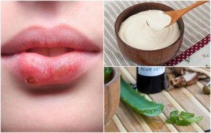 7 effectieve natuurlijke behandelingen voor een koortslip