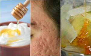 Littekens door acne op je gezicht? Lees over 5 gezichtsmaskers