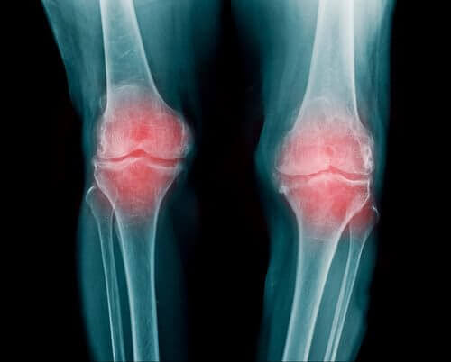 Voorkomen van artrose in de knieën
