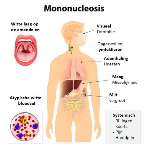 De ziekte van Pfeiffer