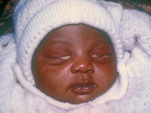 De s,ymptomen van gonorroe bij een baby