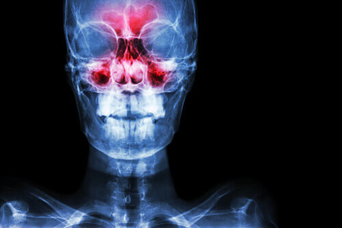 Een röntgenfoto van iemand die last heeft van de symptomen van sinusitis