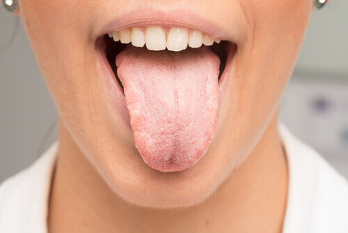Witte aanslag op de tong zien