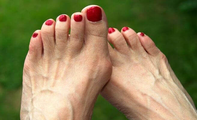 Vrouw met voetproblemen
