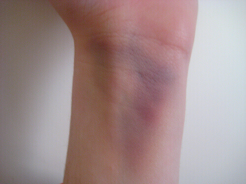 Bananenschillen gebruiken om kneuzingen te verlichten