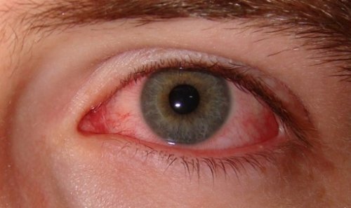 Droge ogen rood oog