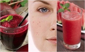 5 ontgiftende smoothies om acne te bestrijden