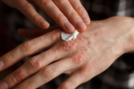 Strepen op de vingernagels door psoriasis