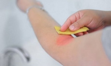 Bananenschillen verzachten insectenbeten