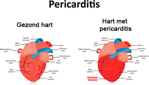 SLE en pericarditis