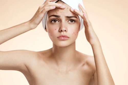 Schoonheidsbehandelingen met tomaat om acne te bestrijden