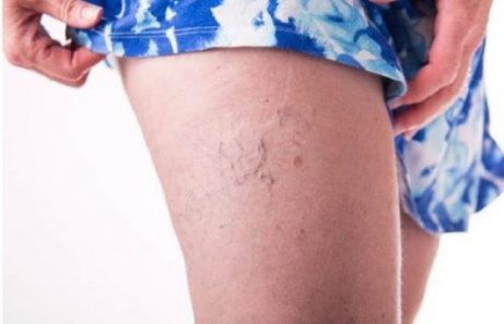 Maak zelf een zalf om spinnenkoppen te verminderen