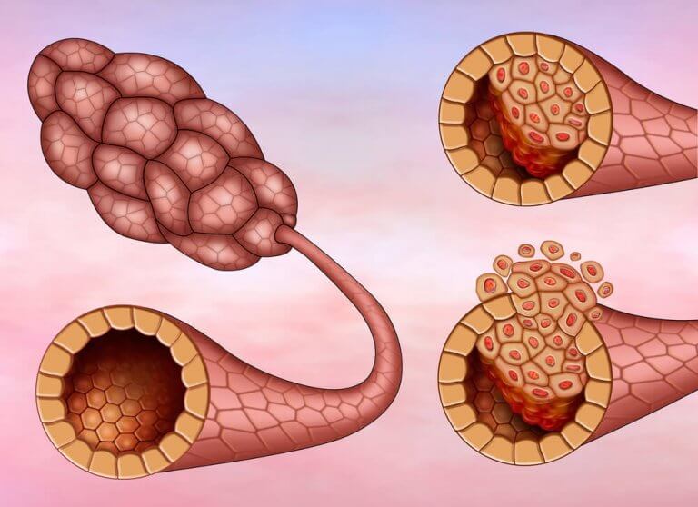 Verschillende soorten borstkanker ductaal carcinoom