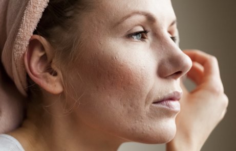 Huidproblemen door een hoog cortisolpeil