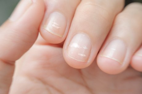 Strepen op de vingernagels door een tekort aan zink