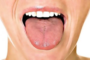 6 thuisremedies voor zweren in de mond