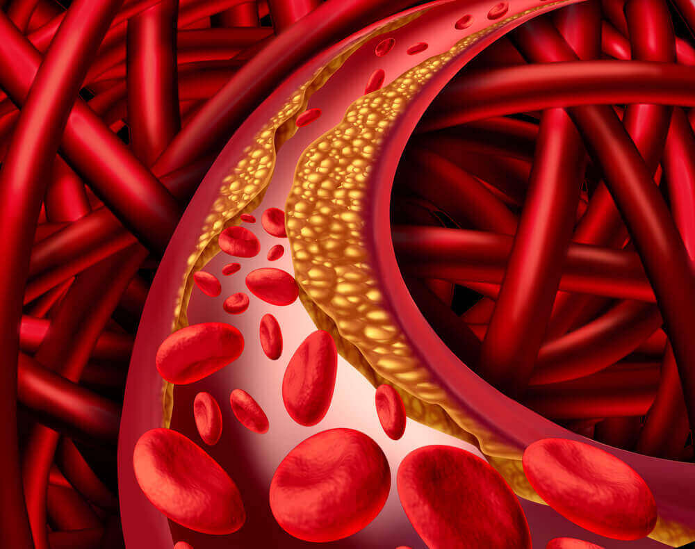 Cholesterol in de aderen