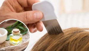 Ontdek enkele huisremedies om luizen te verwijderen