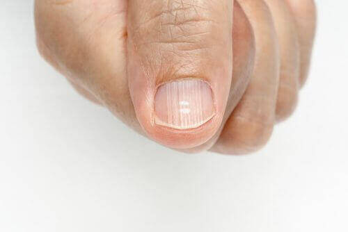 Strepen op de vingernagels zijn signalen van gezondheidsproblemen