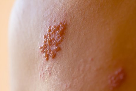 Herpes