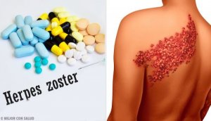 Symptomen van gordelroos en de belangrijkste diagnostische gegevens