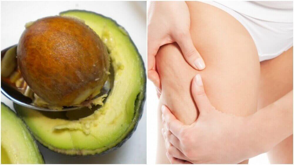 Hoe kun je een avocadopit gebruiken om cellulitis te behandelen?