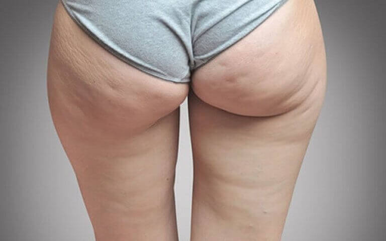Vrouw met cellulitis