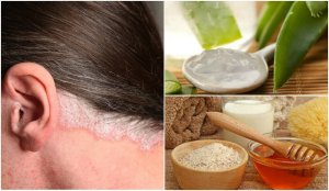 5 huismiddeltjes voor psoriasis van de hoofdhuid