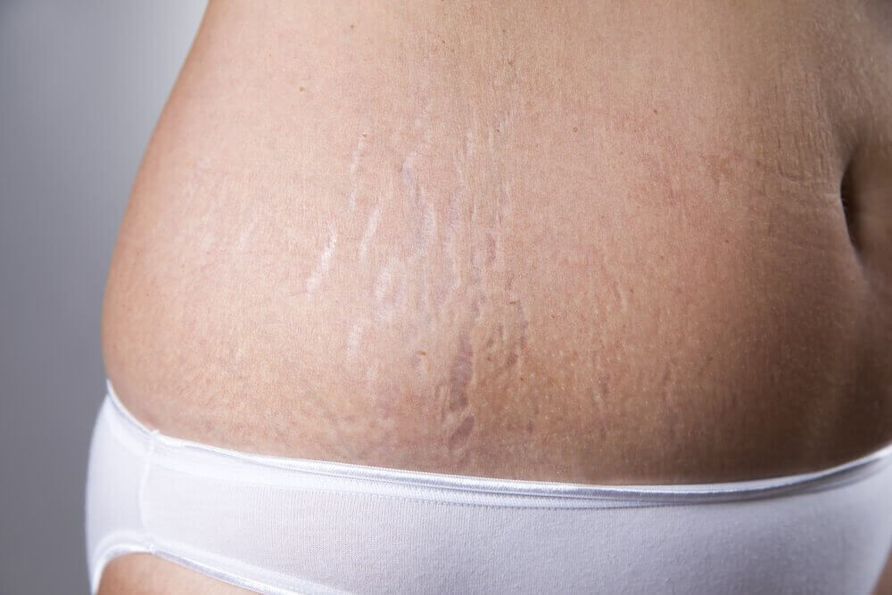 Verminder striemen met vitamine E