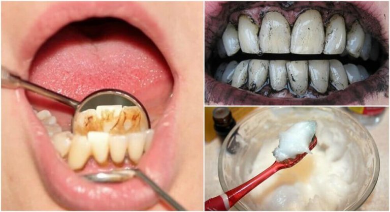 Tandsteen doeltreffend verwijderen met 3 huismiddelen