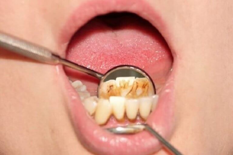 Tandsteen doeltreffend verwijderen