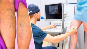 Natuurlijke behandelingen voor spataderen