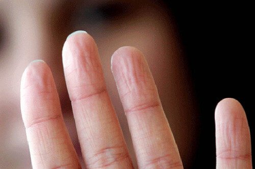 Ovematig yweten en de handen