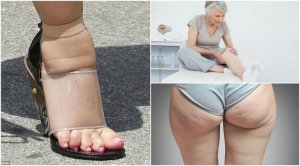 5 veelvoorkomende symptomen van vochtretentie