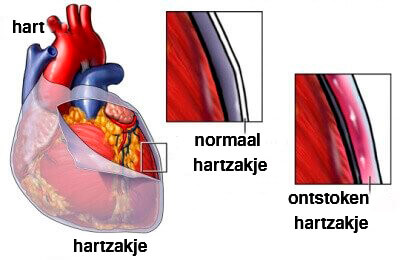 Pericarditis
