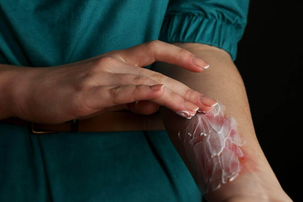 Brandzalf aanbrengen