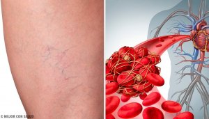 De 3 beste huismiddeltjes voor flebitis of aderontsteking