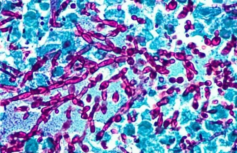 Vaginale candidiasis