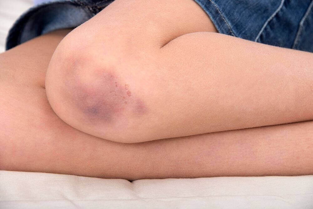 Toepassingen van vaseline bij kneuzingen