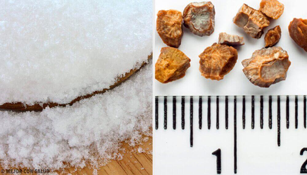 Zelfgemaakte remedies tegen nierstenen