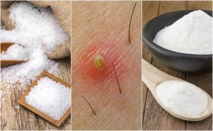 5 natuurlijke oplossingen voor ingegroeide haartjes