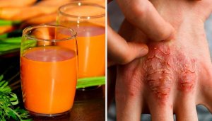 Voorkom en vecht tegen huidaandoening psoriasis met deze 7 natuurlijke remedies