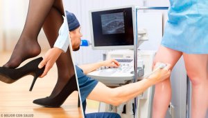 Spataders verminderen met deze natuurlijke tips