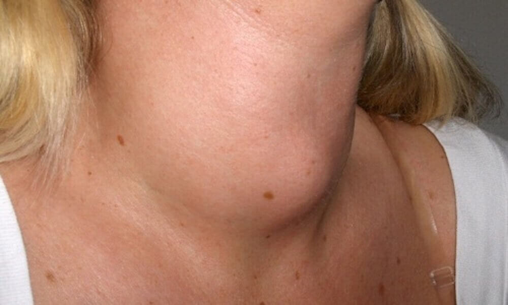 Vroege tekenen van keelkanker: zwelling in de nek